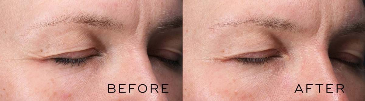 SMedik8 skin peel results