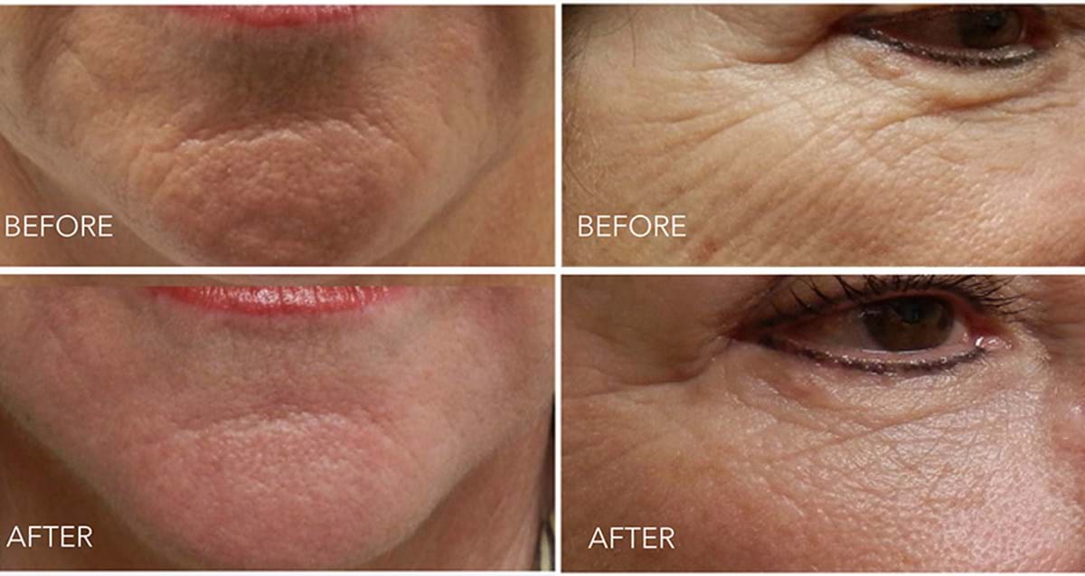 Chin (left), Under Eye (right) before and after skin needling treatment