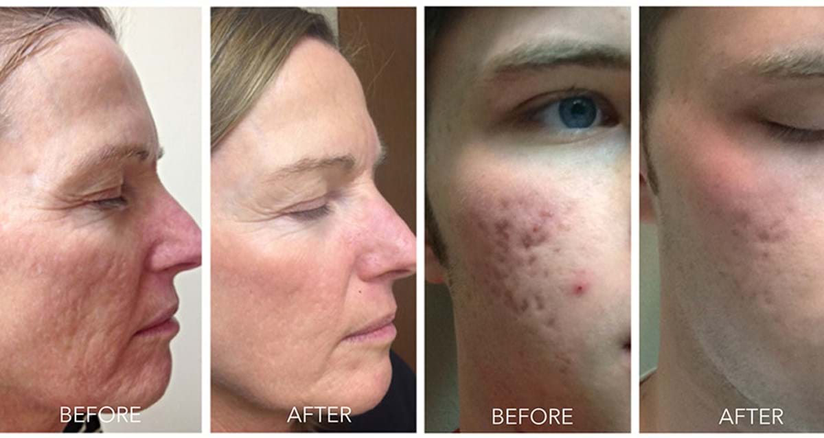 Acne Scarring before and after skin needling treatment