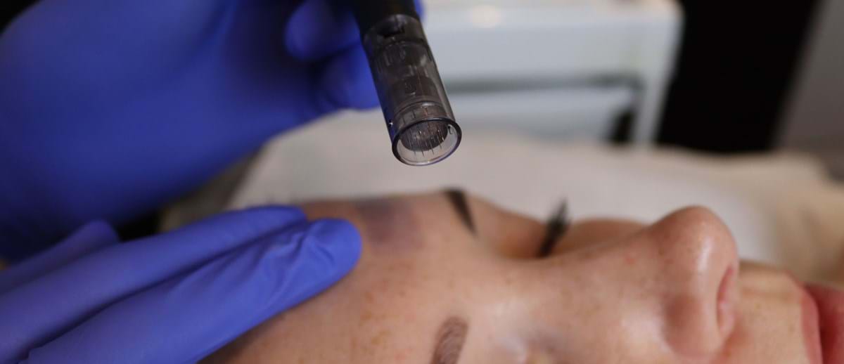 Skin needling services