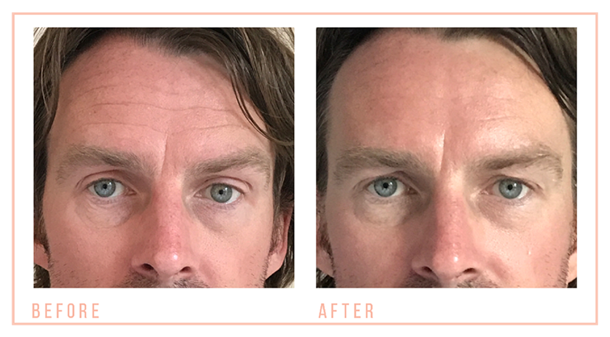 Non-surgical face lift