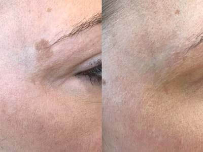 Age Spots / Pigmentation / Sun Damage