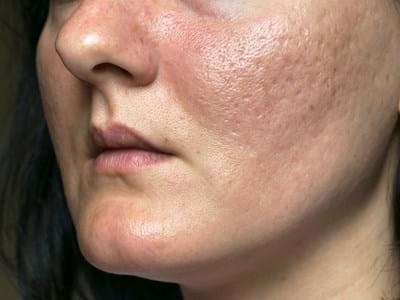 Scarring, Stretch Marks and Open Pores