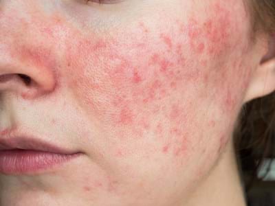 Rosacea / Redness / Reactive