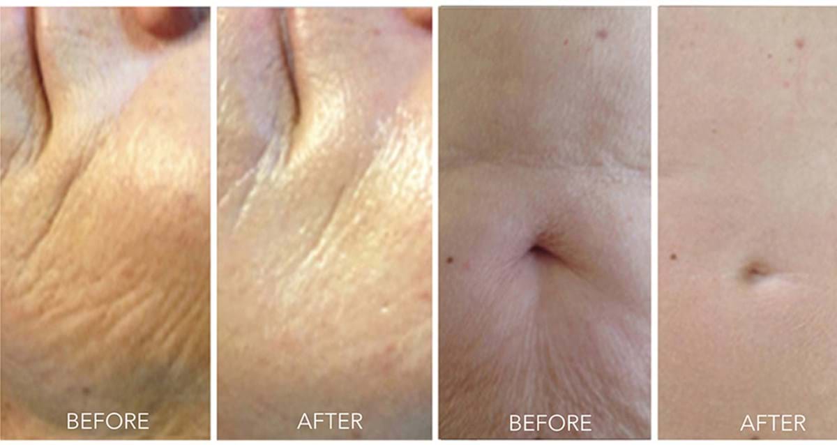 Wrinkles before and after skin needling treatment