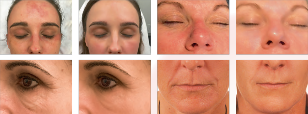 Before and after Byonik Laser treatment