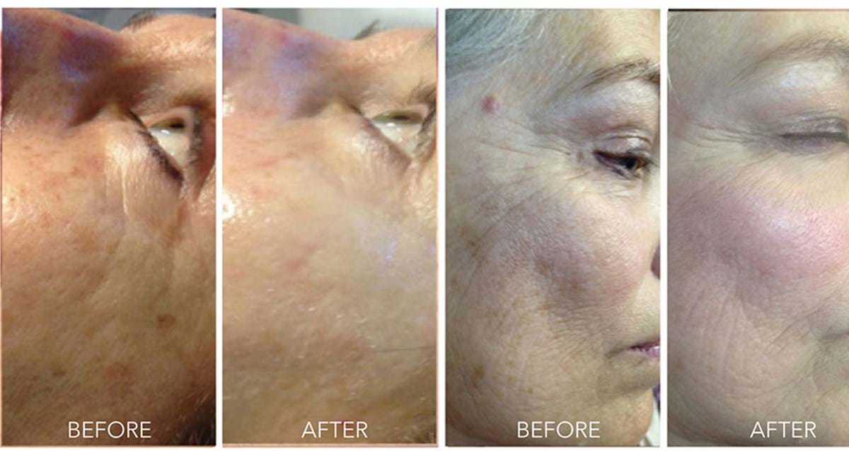 Pigmentation before and after skin needling treatment