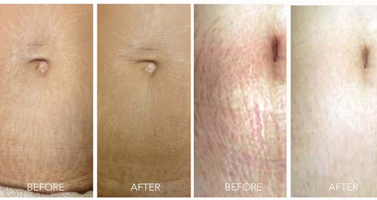 Stretch marks before and after skin needling treatment