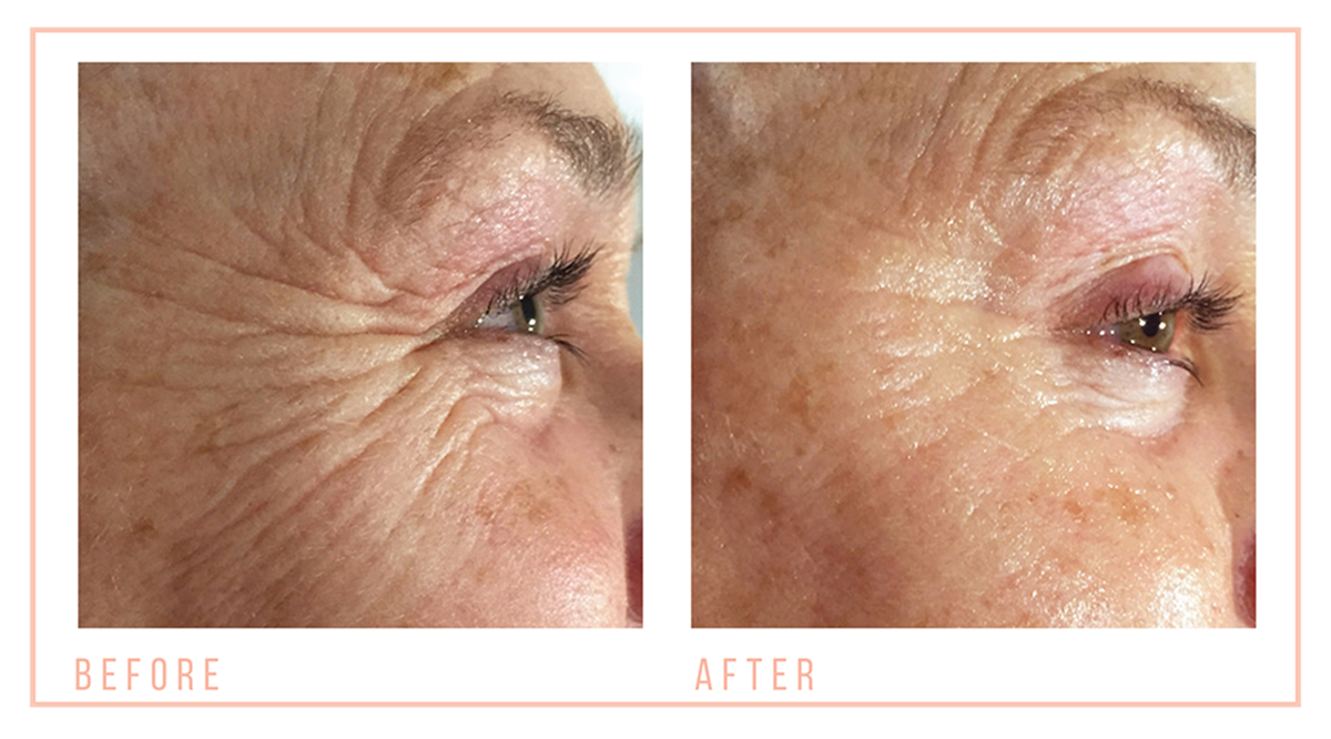 Caci eye revive