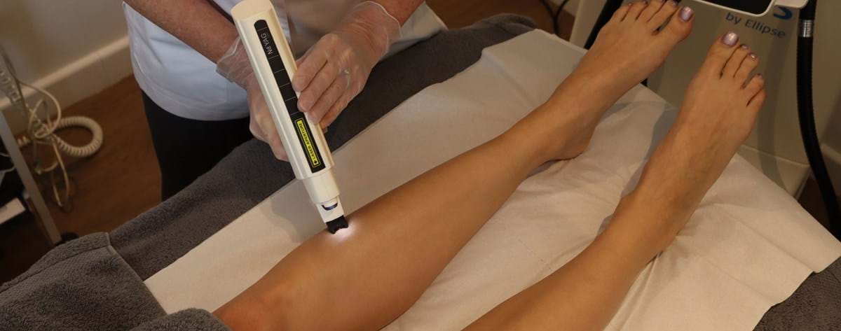 Laser leg vessel treatment