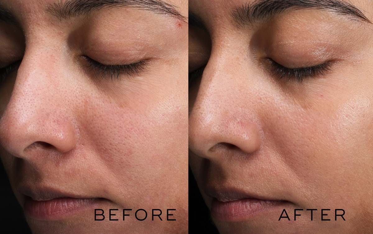 Medik8 Skin Peels Benefits